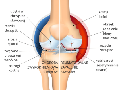 Zapalenie stawów. Reumatyzm. Choroba zwyrodnieniowa stawów. Leczenie miejscowe, dieta i ćwiczenia terapeutyczne