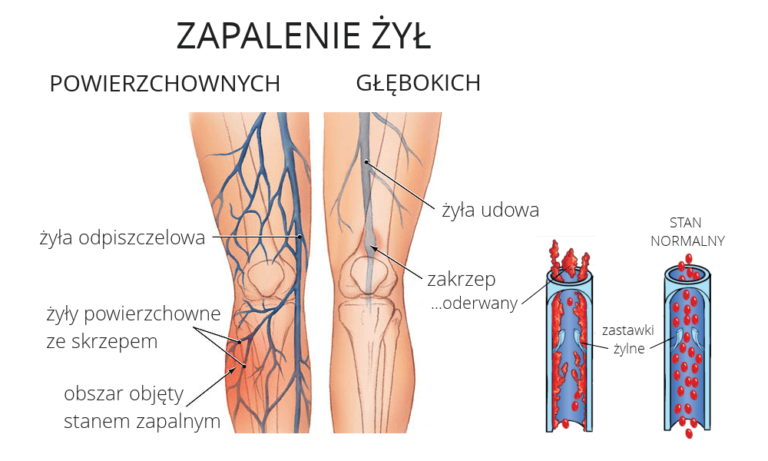 Zapalenie i zakrzepica żył Objawy Leczenie Profilaktyka Naturalnie