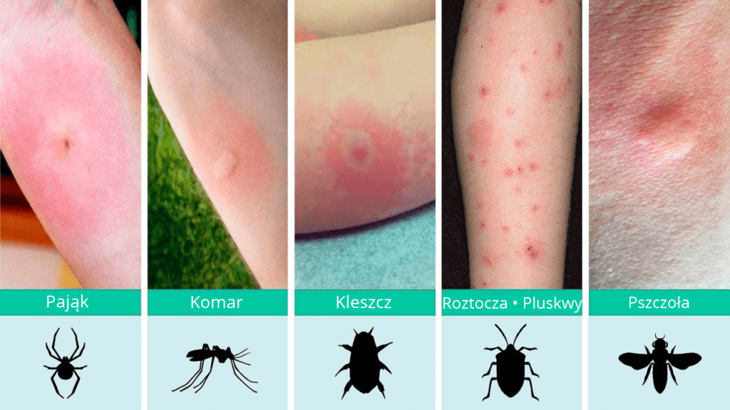 Ukąszenia. Kleszcze, komary, muchy, pluskwy, pająki… Leczenie i zapobieganie