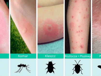 Ukąszenia. Kleszcze, komary, muchy, pluskwy, pająki... Leczenie i zapobieganie