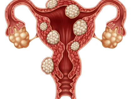 Endometrioza. Objawy i przyczyny. Leczenie i profilaktyka, w tym dieta i seks