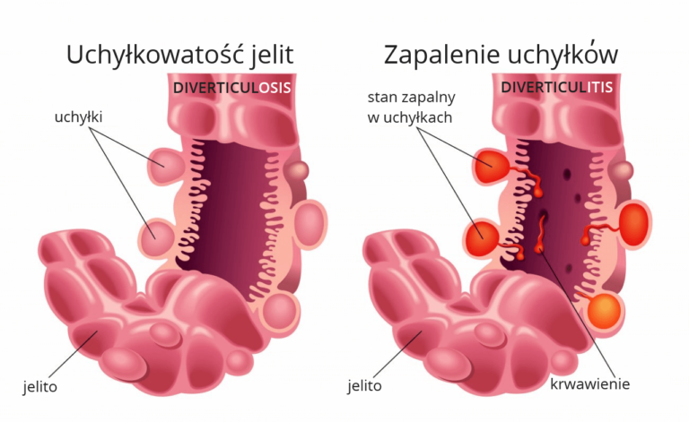 Uchyłki Jelita Grubego Zapalenie Uchyłków I Uchyłkowatość Dieta • L And P 9162